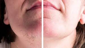 Απαλλαγείτε από την τριχοφυΐα στο πρόσωπο με φυσικό τρόπο!