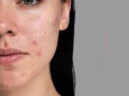 Τρόποι να εμποδίσεις την έξαρση της ακμής το φθινόπωρο