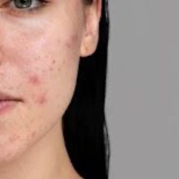 Τρόποι να εμποδίσεις την έξαρση της ακμής το φθινόπωρο