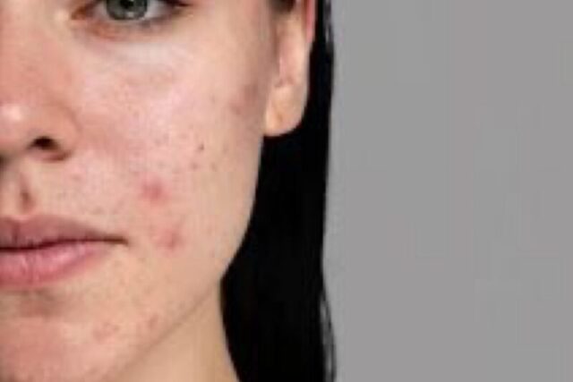 Τρόποι να εμποδίσεις την έξαρση της ακμής το φθινόπωρο