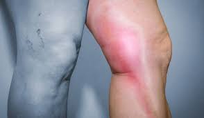 Θρόμβωση: μια συχνή πάθηση που υποτιμούμε